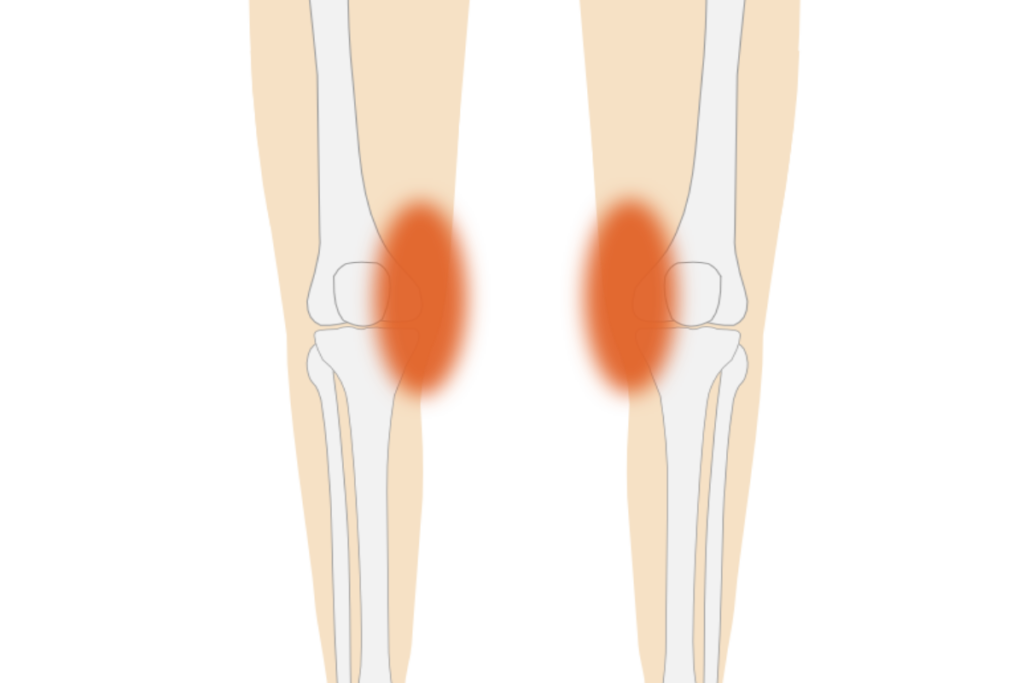 左右の膝の関節に赤い痛みの部分を示したイラスト
