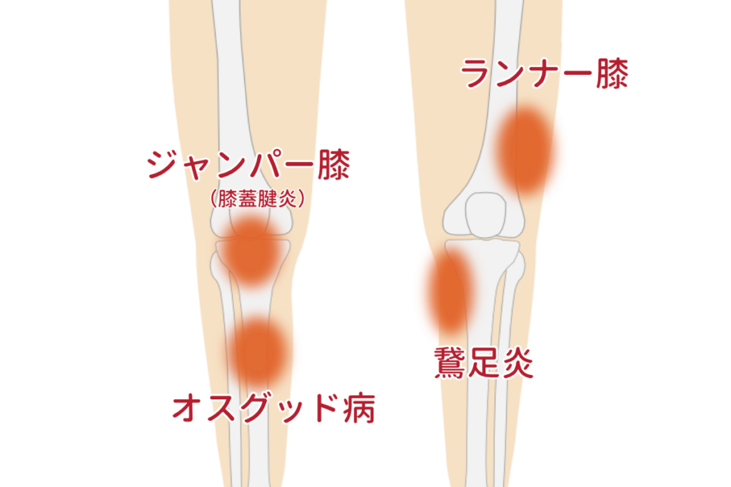 膝と足の代表的なスポーツ障害を示す医療イラスト 赤い部分で痛みの箇所を表示
