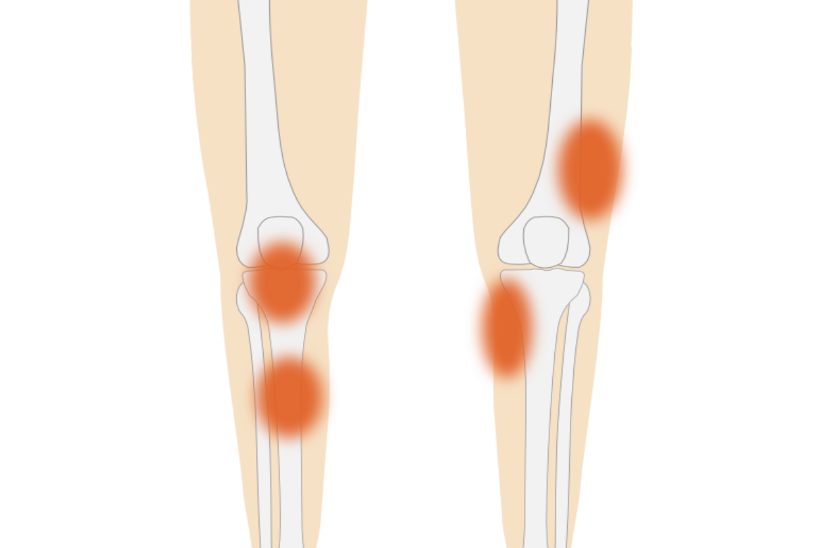 左右のひざの骨格イラストと痛みを示す赤い丸印の位置の違いを比較した図解