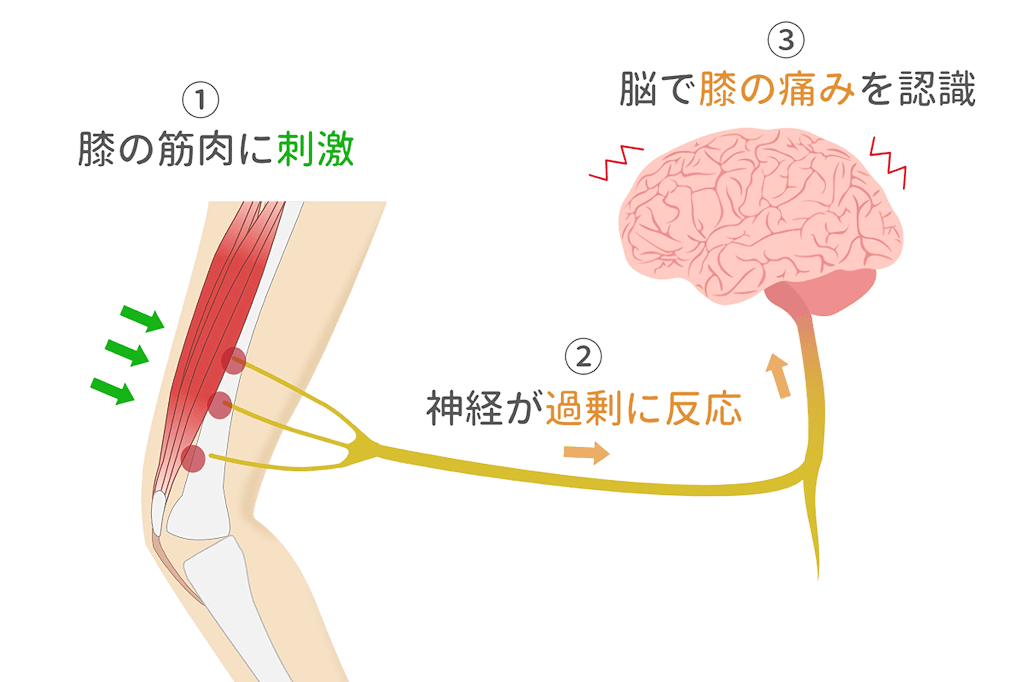 膝の筋肉への刺激が神経を通じて脳に伝わり痛みとして認識される仕組みを示すイラスト