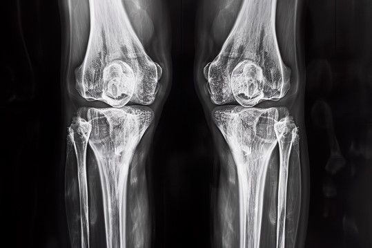 両膝のレントゲン写真で見える膝関節の骨の様子